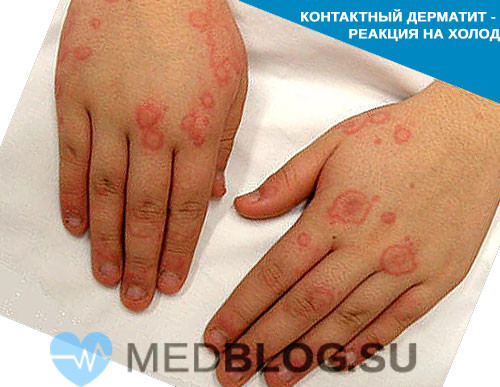 Аллергия на холод: симптомы на руках