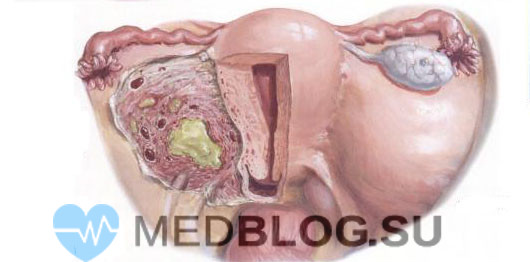 Параметрит - воспаление параметральной клетчатки, в т.ч. после родов и гинекологических операций