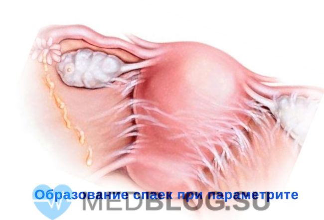 параметрит фото Параметрит: образование спаек без лечения