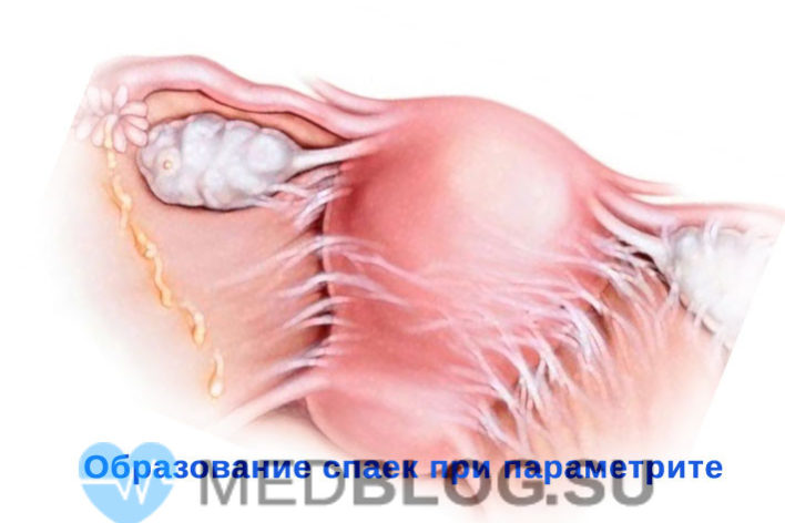 параметрит фото Параметрит: образование спаек без лечения