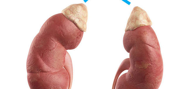 Гипокортицизм - иллюстрация болезни Аддисона