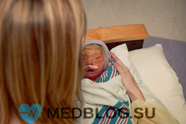 Ихтиоз арлекина фото