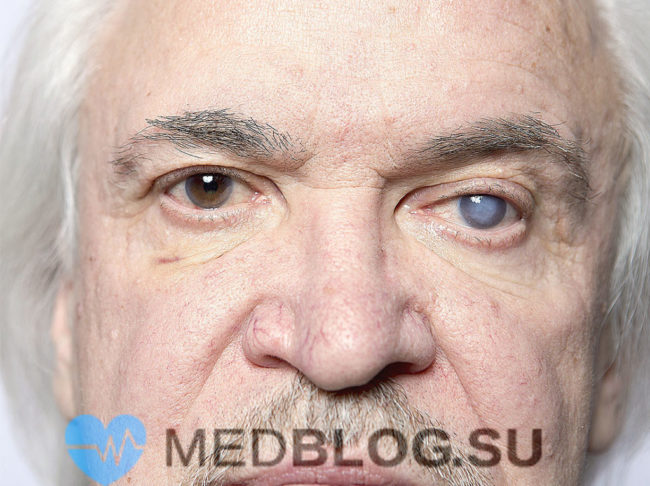 Народные средства лечения глаукомы