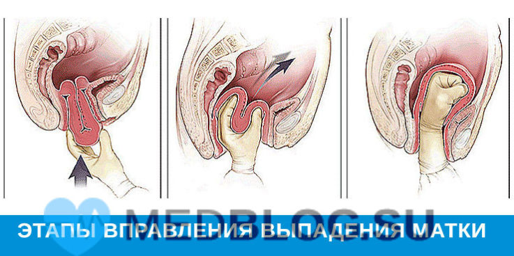 Выпадение матки лечение Вправление выпадения матки у женщин