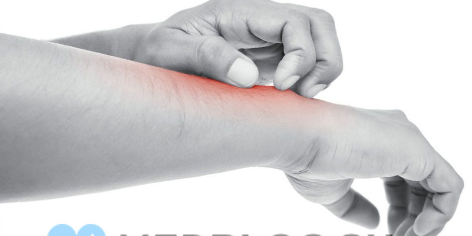 allergicheskiy-dermatit-lec Аллергический дерматит - симптомы и лечение