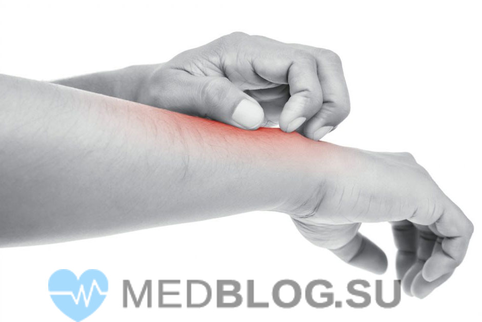 allergicheskiy-dermatit-lec Аллергический дерматит - симптомы и лечение