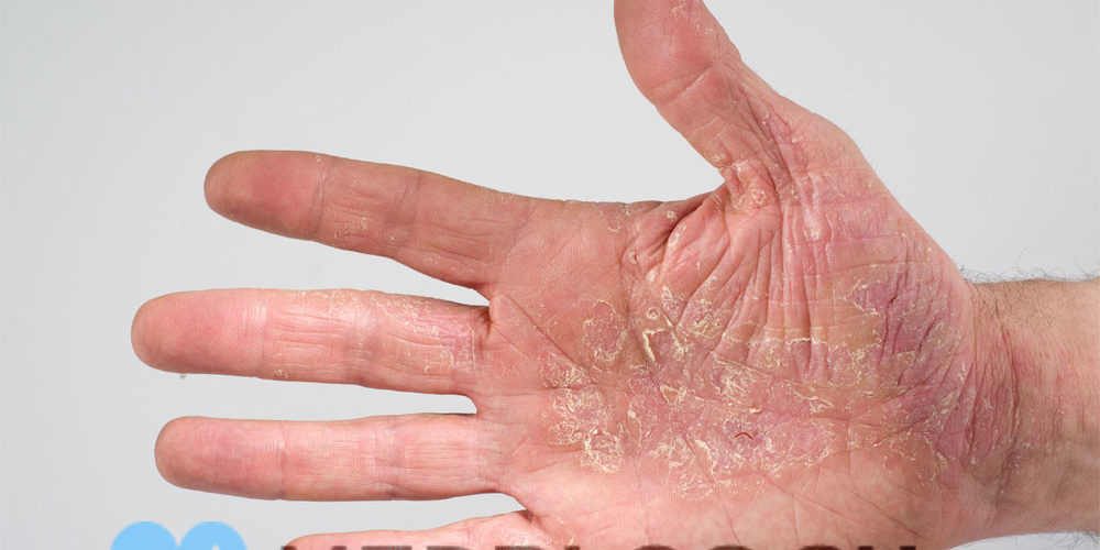 atopicheskiy-dermatit-foto2 Атопический дерматит фото, симптомы, лечение