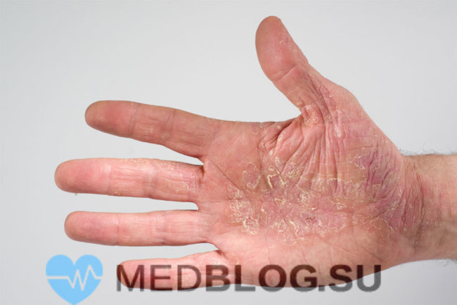 Атопический дерматит фото, симптомы, лечение