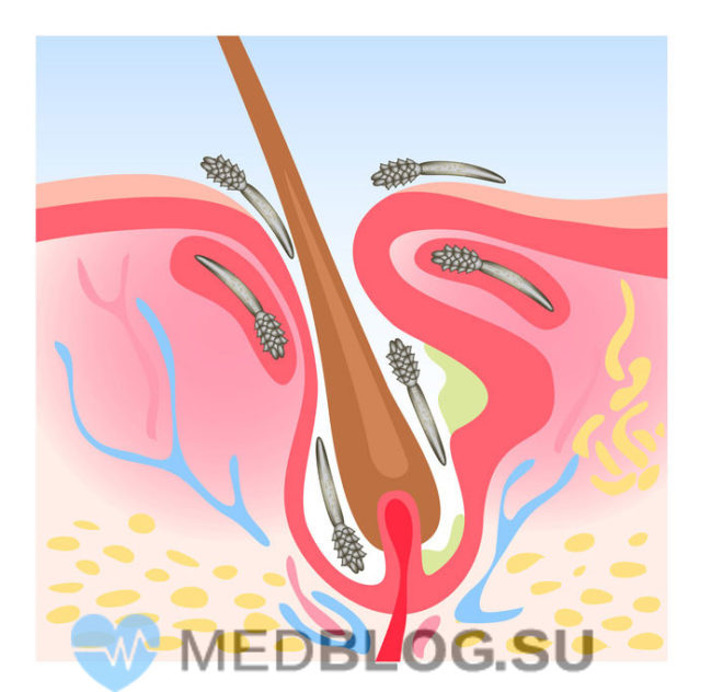 demodekoz-lechenie Демодекоз: симптомы, анализы, лечение