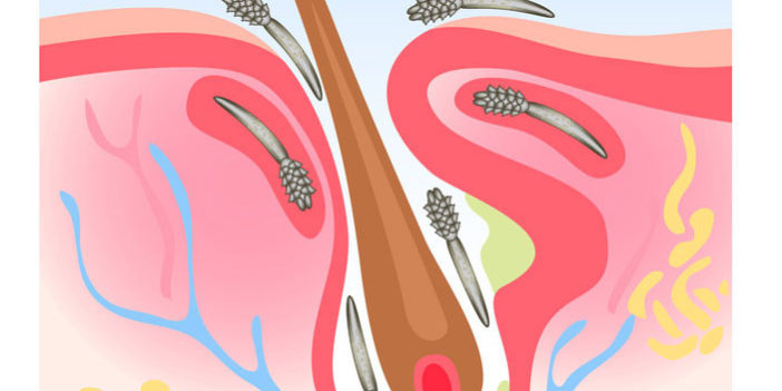 demodekoz-lechenie Демодекоз: симптомы, анализы, лечение