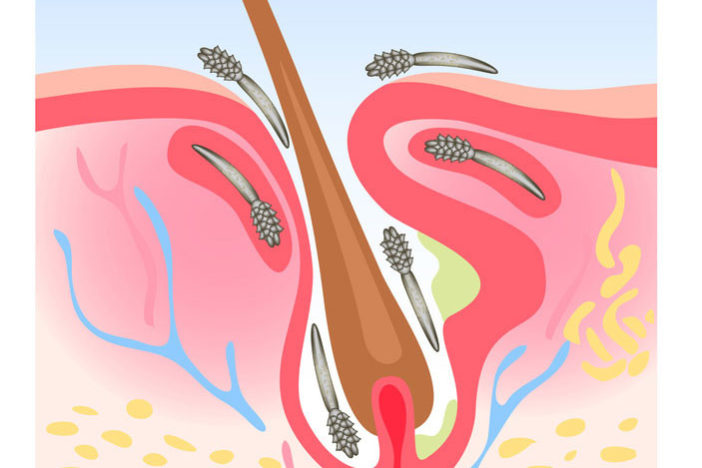 Демодекоз: симптомы, анализы, лечение