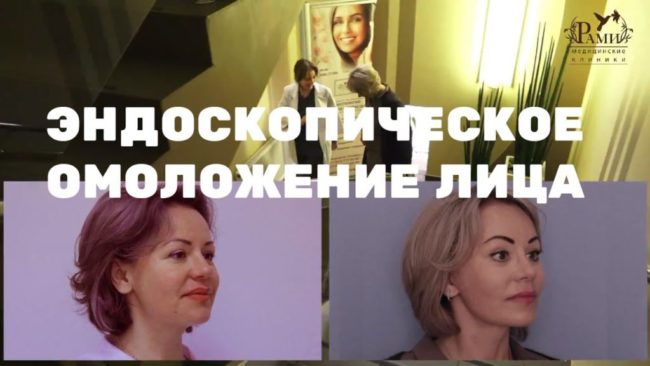 Фейслифтинг (эндоскопическая подтяжка лица)