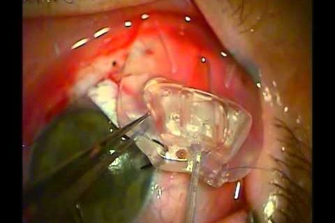 Glaucoma Surgery. Ahmed valve. Хирург Ермолаев А.П.