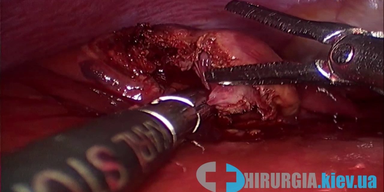 Лапароскопия кисты печени (перицистєктомия)