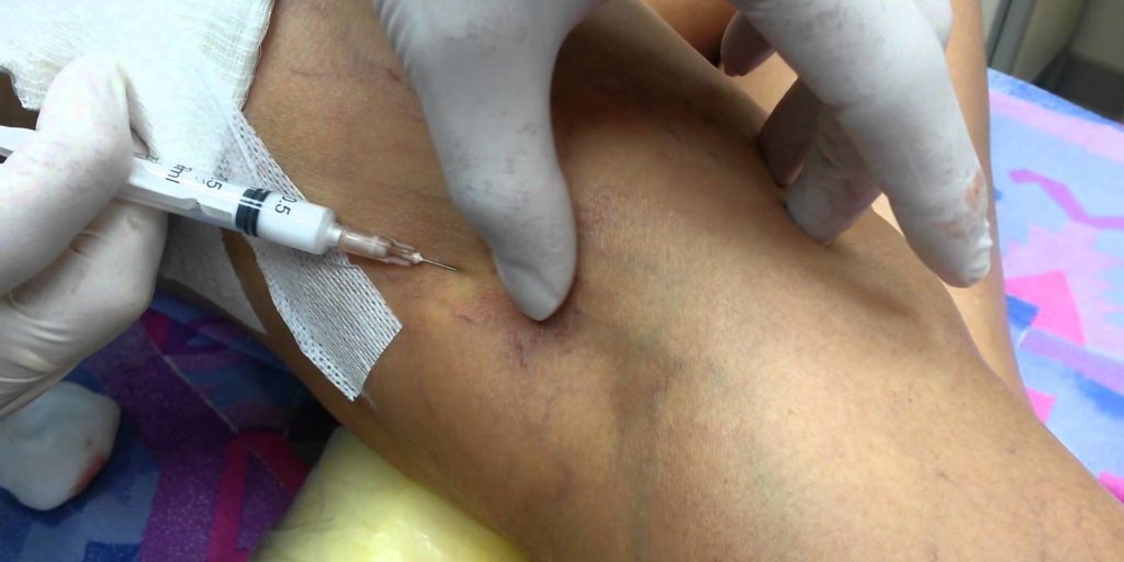 Лечение сосудистых звездочек на ногах