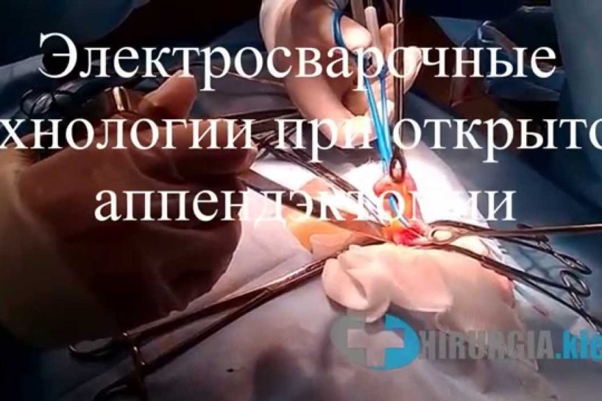 Открытая аппендэктомия с применением электросварочных технологий