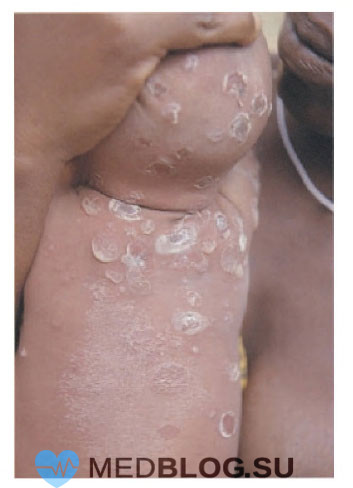 Пемфигус при врожденном сифилисе