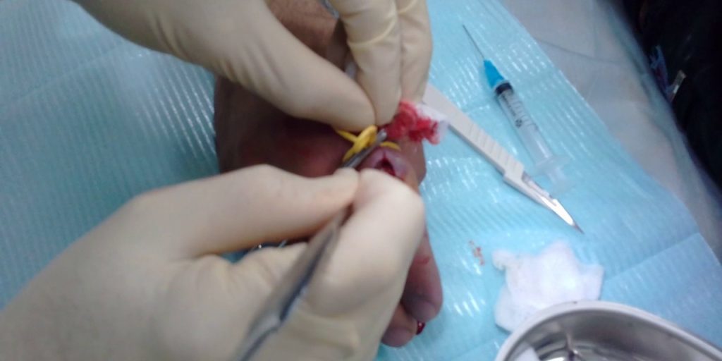 Подкожный панариций лечение хирургическим путем