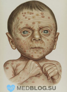 Врожденный сифилис у ребенка фото