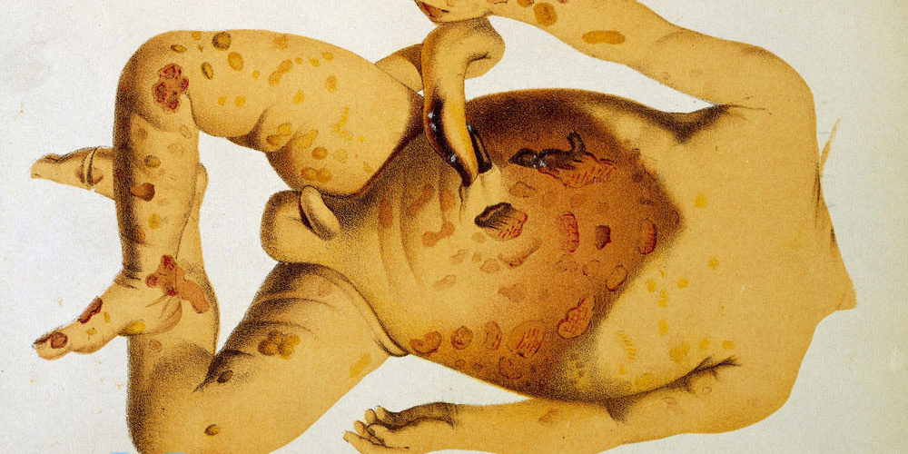 sifilis-u-rebenka-photo4 Врожденный сифилис у ребенка