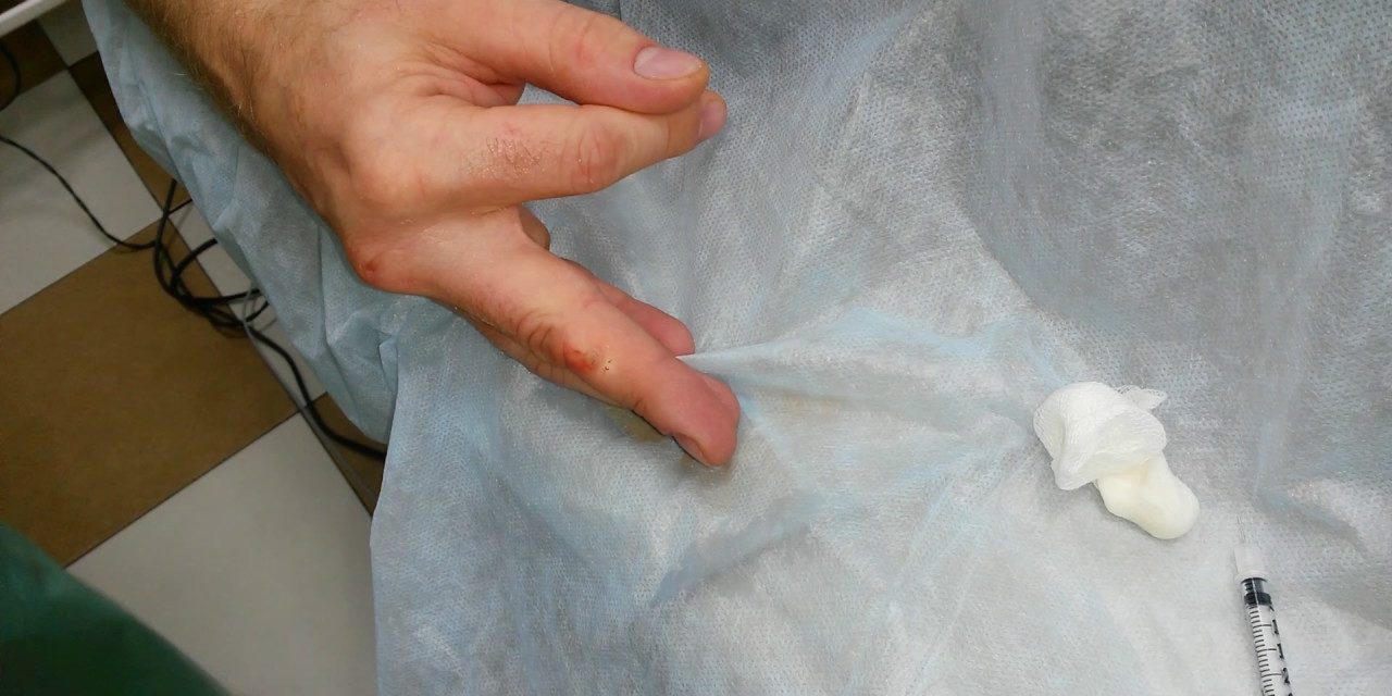 Удаление папилломы радиоволновым методом