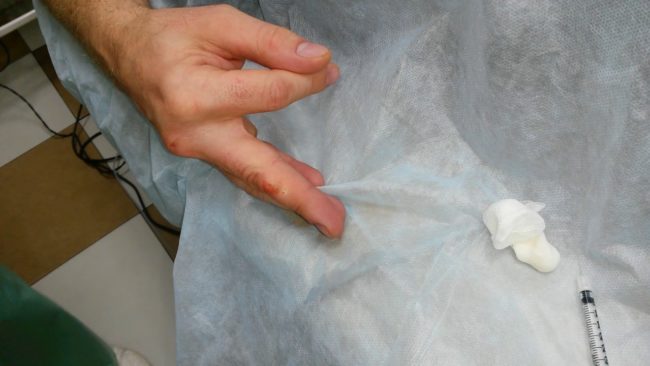 Удаление папилломы радиоволновым методом