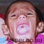 Врожденный сифилис у ребенка
