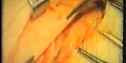 Герниотомия и герниопластика паховых грыж