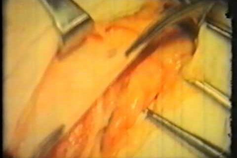 Герниотомия и герниопластика паховых грыж