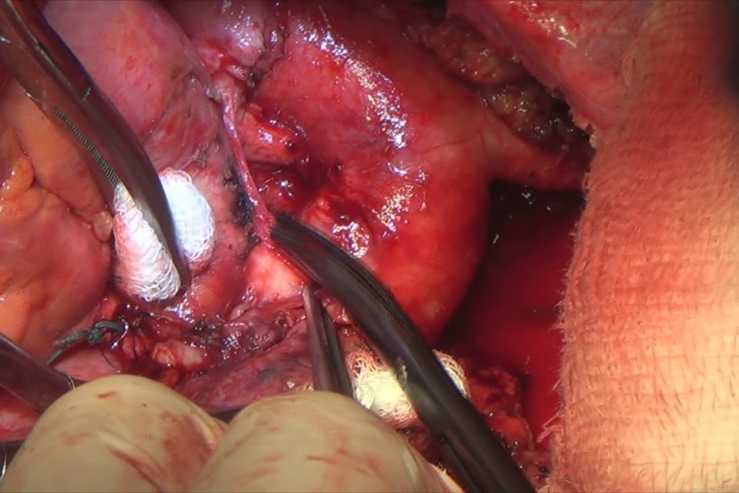 Комбинированная пневмонэктомия с резекцией и пластикой аорты и легочного ствола off pump (РНЦХ)