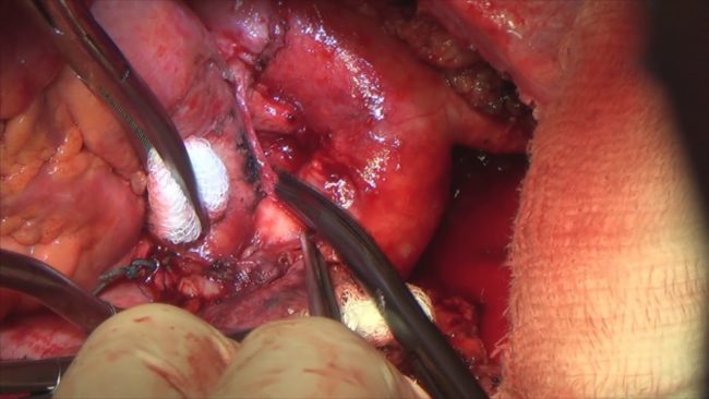 Комбинированная пневмонэктомия с резекцией и пластикой аорты и легочного ствола off pump (РНЦХ)