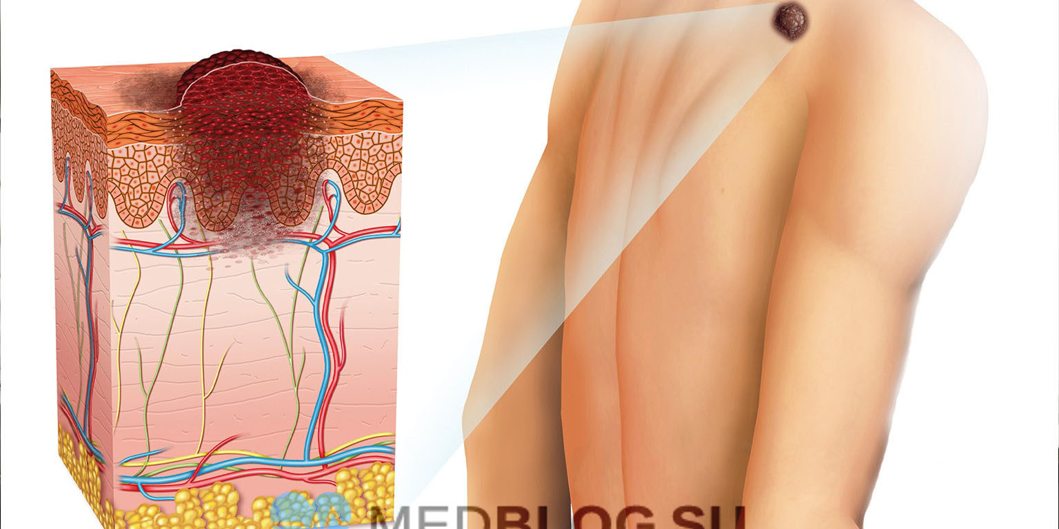 neopasnie-rodinki-na-tele Фото какие родинки опасные и неопасные у взрослых