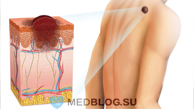 neopasnie-rodinki-na-tele Фото какие родинки опасные и неопасные у взрослых