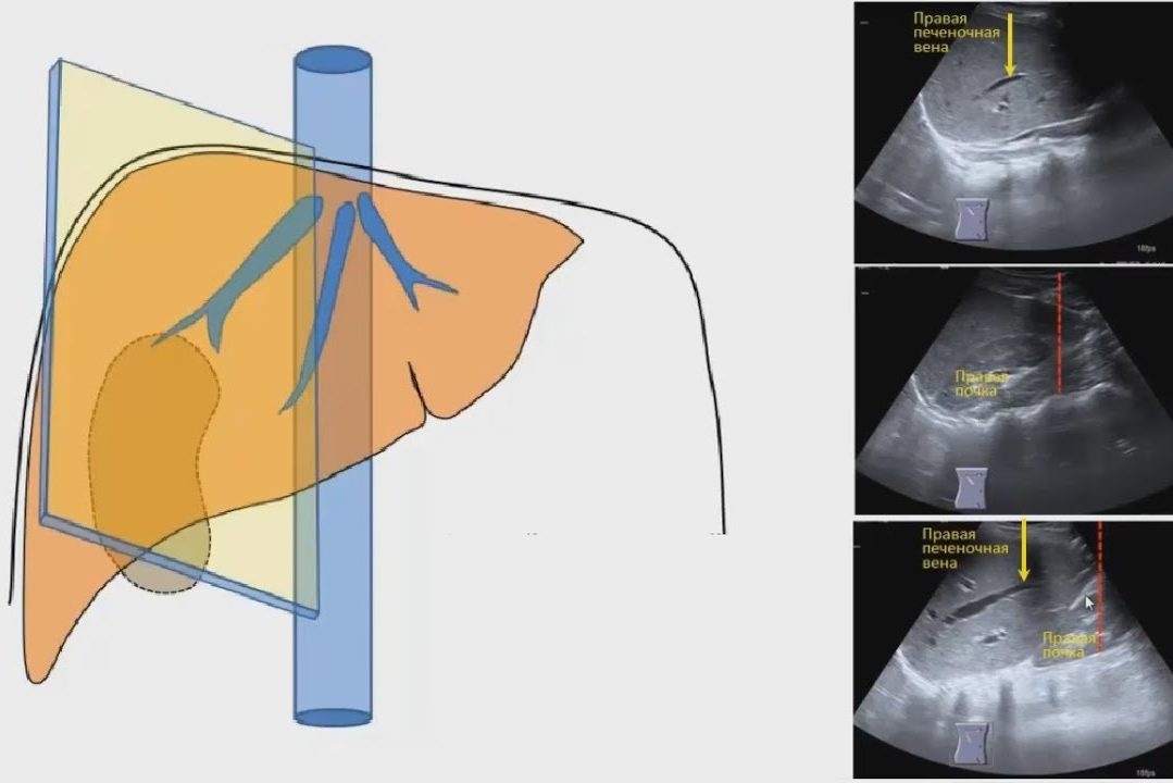 Плоскости ультразвукового сканирования печени