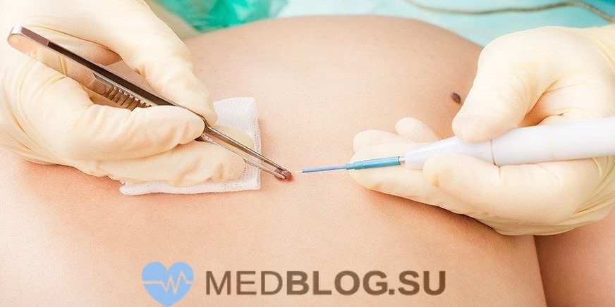 prichini-poyavleniya-visyachih-rodinok Причины появления висячих родинок на теле