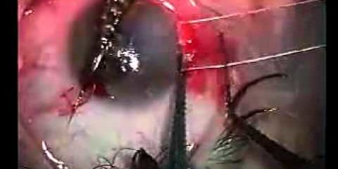 Проникающее ранение рыболовным крючком