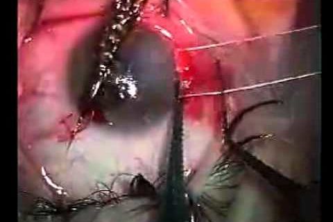 Проникающее ранение рыболовным крючком