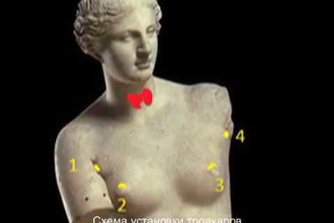 Рак щитовидной железы. Роботическая тиреоидэктомия (Da Vinci)