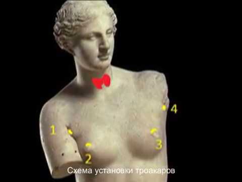 Рак щитовидной железы. Роботическая тиреоидэктомия (Da Vinci)