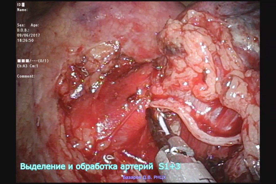 Торакоскопическая верхняя лобэктомия слева (РНЦХ им.акад.Б.В.Петровского)