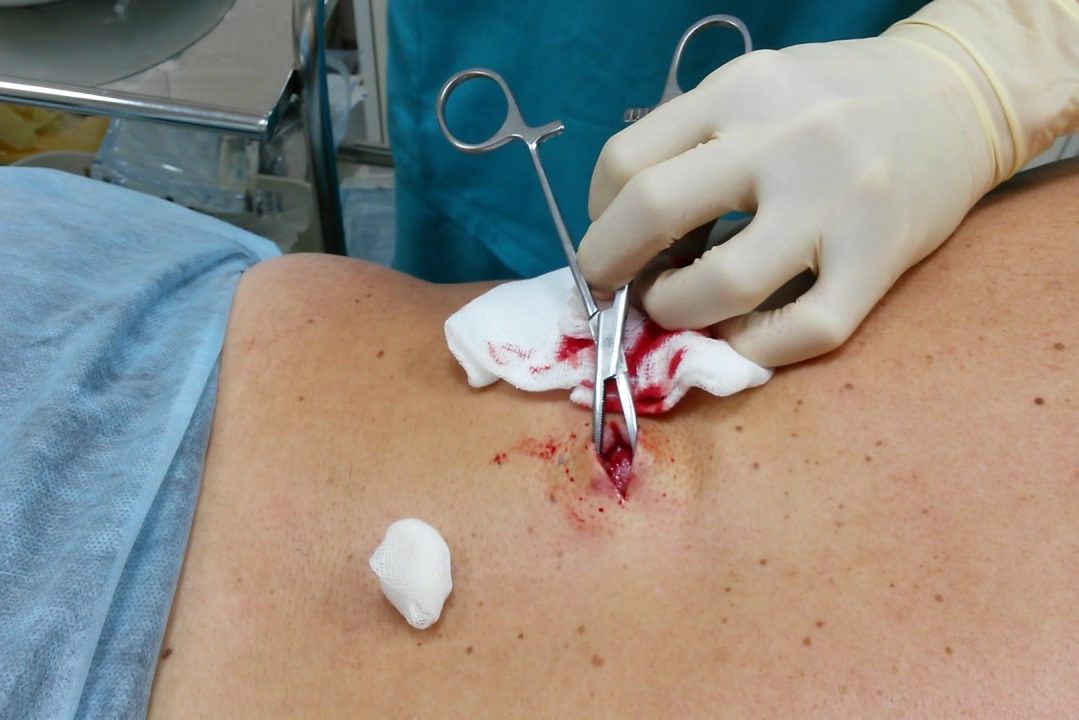 Удаление атеромы с капсулой при нагноении