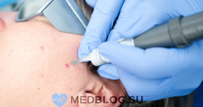 УВ-удаление родинки в области уха Можно ли удалять родинки на лице