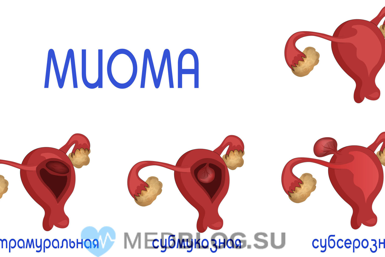 Интрамуральная, субмукозная и субсерозная миома матки