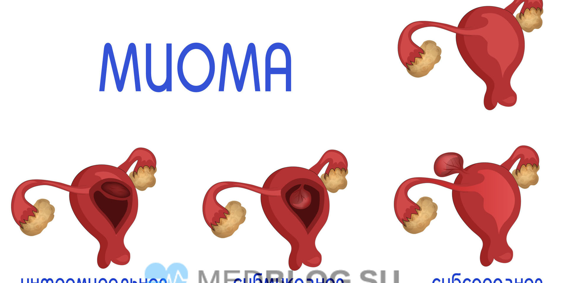 vidi-miomi-matki Интрамуральная, субмукозная и субсерозная миома матки