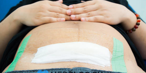 Воспаление шва и матки после кесарева сечения