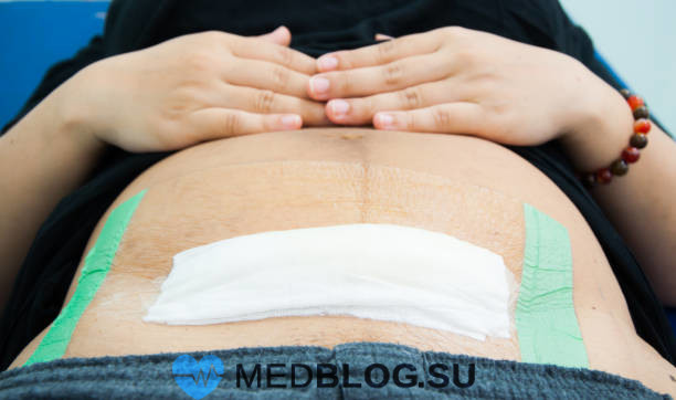 cesarean Воспаление шва и матки после кесарева сечения