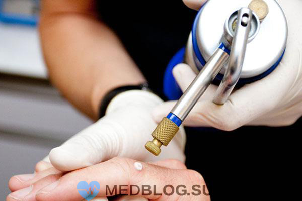 cryotherapy Криотерапия