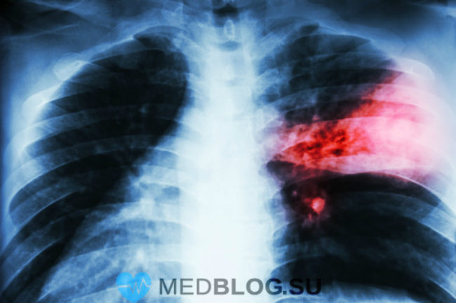 gnoinie-destruktivnie-zabolevaniya-legkih Гнойные деструктивные заболевания легких
