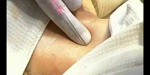 Катетеризация яремной вены