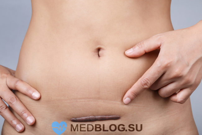 keloid-c-section keloid-c-section